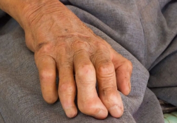 आज कुष्ठरोग दिवसः सबैभन्दा धेरै कुष्ठरोगी मधेस प्रदेशमा