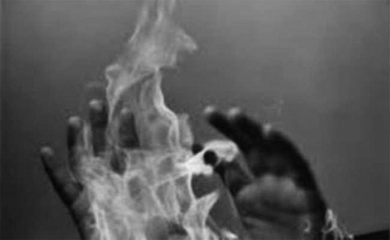 रविलाई न्याय गर्नु पर्ने भन्दै जुम्लामा एक युवकले गरे आत्मदाहको प्रयास