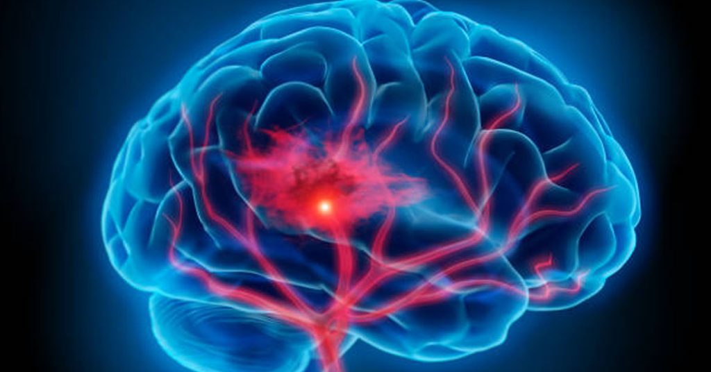 आज विश्व पक्षाघात दिवस