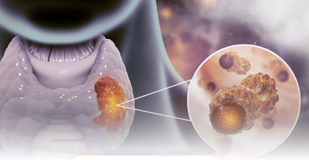 बालबालिकाको क्यान्सर चाँडै निको हुन्छ