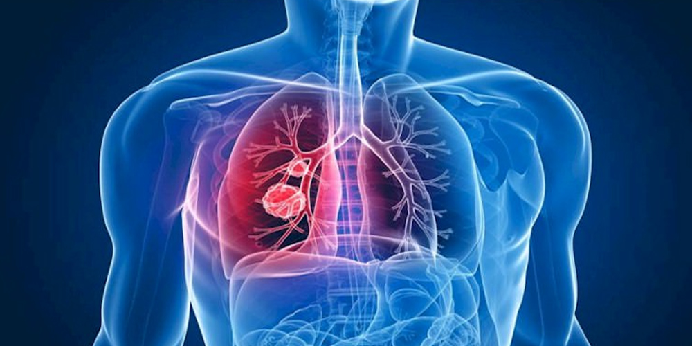 विश्व क्षयरोग दिवसः संक्रमण र मृत्युदरमा वृद्धि