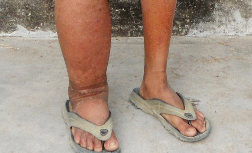 झापामा आठ लाखलाई हात्तीपाइले रोगविरुद्धको औषधि