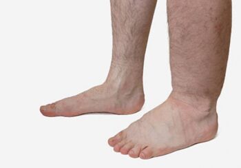 नेपालगञ्जमा हात्तीपाइलेविरुद्धको औषधि सेवन सुरु