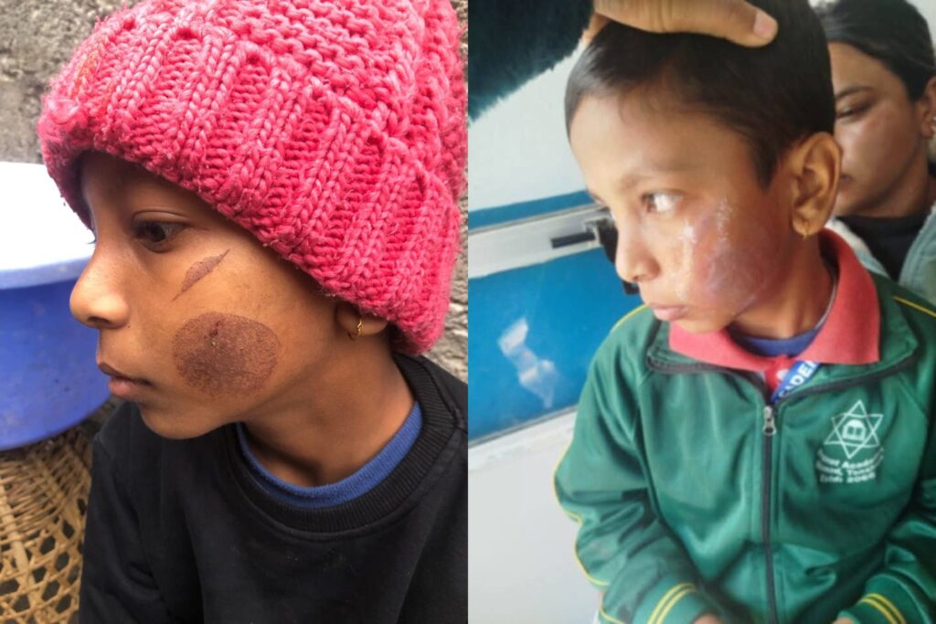 तातो पन्यूले विद्यार्थीको गाला डाम्ने प्रिन्सिपलकी छोरी पक्राउ