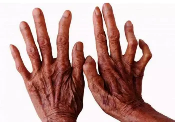 कुष्ठरोग प्रभावितसँग सम्बन्धित नीति तथा कानुन पुनरावलोकन गर्न सुझाव