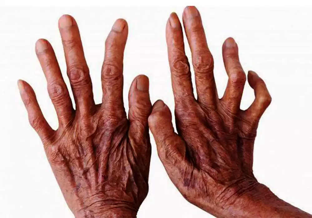 कुष्ठरोग प्रभावितसँग सम्बन्धित नीति तथा कानुन पुनरावलोकन गर्न सुझाव